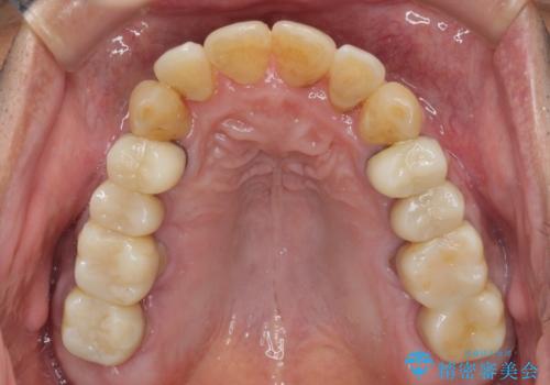 歯列不正と歯周病 総合歯科治療による全顎治療の治療中