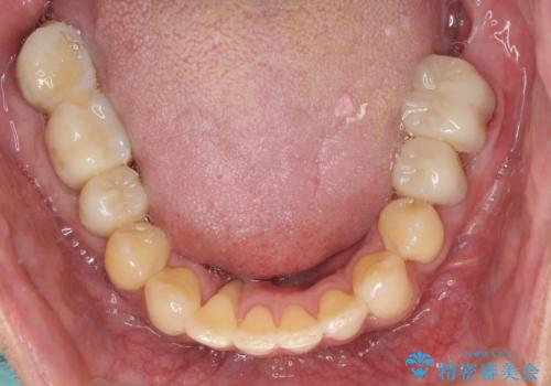 歯列不正と歯周病 総合歯科治療による全顎治療の治療中