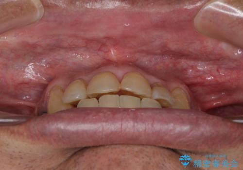 歯列不正と歯周病 総合歯科治療による全顎治療の治療中