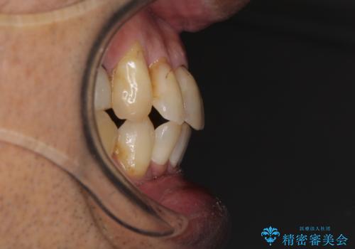 歯列不正と歯周病　総合歯科治療による全顎治療の治療中