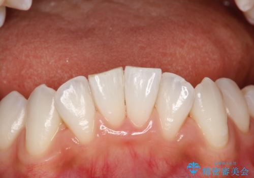 前歯の茶色をPMTCで綺麗に白くの治療後