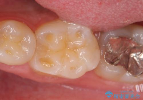 オールセラミッククラウン 知覚過敏の治療の治療前