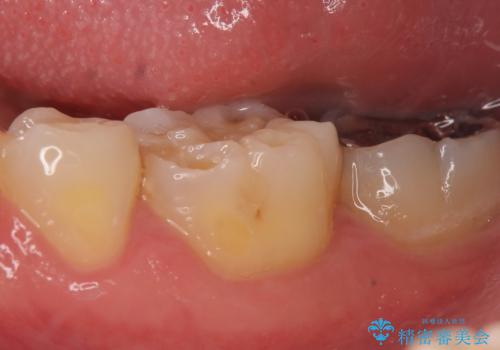 オールセラミッククラウン 知覚過敏の治療の症例 治療前