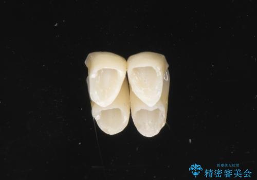 下の前歯の色が気になる セラミックで綺麗に 40代男性の治療中