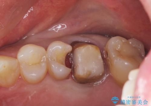 金属をセラミックにしたい、根管治療も行ったケースの治療中