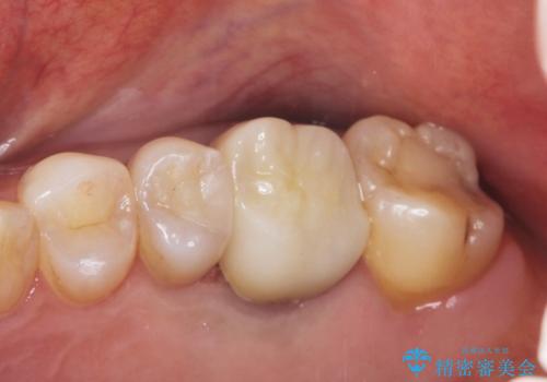 金属をセラミックにしたい、根管治療も行ったケースの症例 治療後