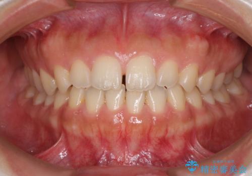 気になる隙間の再矯正　前歯をインビザライン・ライトで改善の症例 治療前