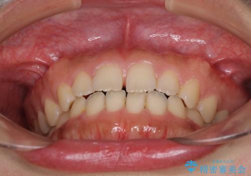 気になる隙間の再矯正 前歯をインビザライン・ライトで改善の治療前