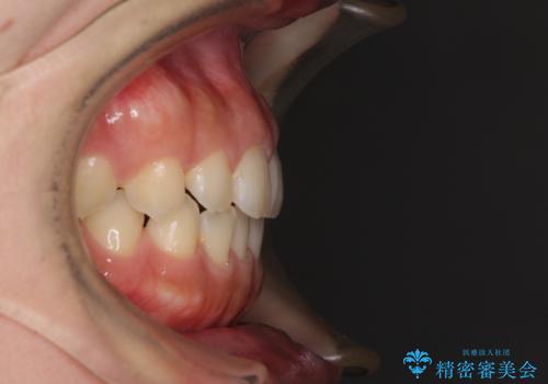 気になる隙間の再矯正 前歯をインビザライン・ライトで改善の治療前