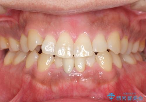 下の前歯の色が気になる セラミックで綺麗に 40代男性の治療後