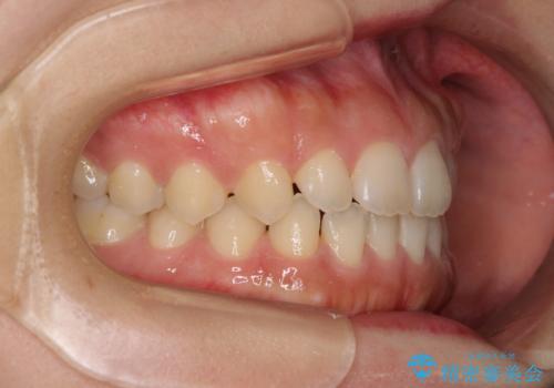 気になる隙間の再矯正 前歯をインビザライン・ライトで改善の治療前