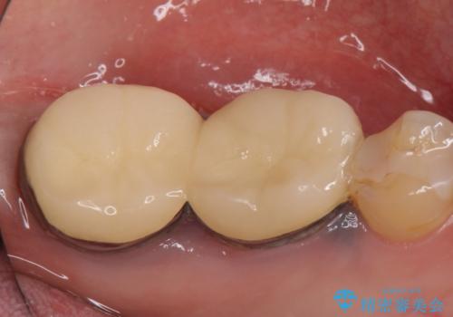 オールセラミッククラウン　治らない歯茎の腫れの治療前