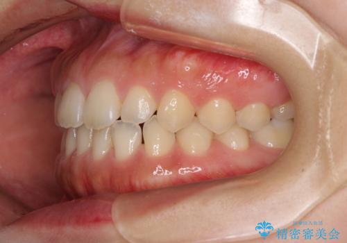 気になる隙間の再矯正　前歯をインビザライン・ライトで改善の治療前