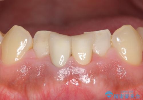 下の前歯の色が気になる セラミックで綺麗に 40代男性の治療後