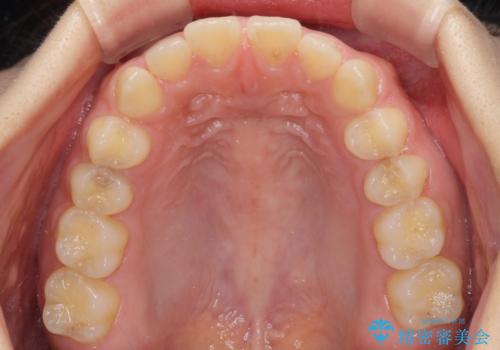 気になる隙間の再矯正 前歯をインビザライン・ライトで改善の治療前