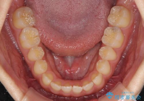 気になる隙間の再矯正 前歯をインビザライン・ライトで改善の治療前