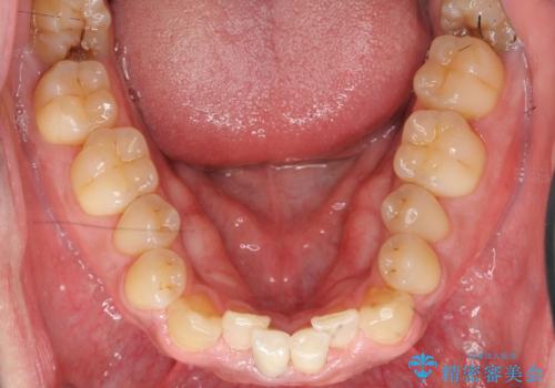 下の前歯の色が気になる セラミックで綺麗に 40代男性の治療後