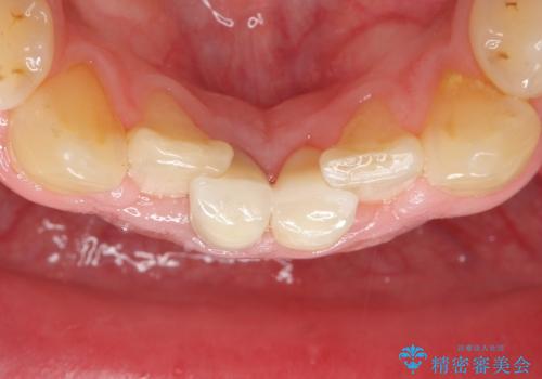 下の前歯の色が気になる セラミックで綺麗に 40代男性の治療後