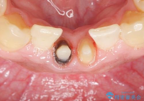 下の前歯の色が気になる セラミックで綺麗に 40代男性の治療中