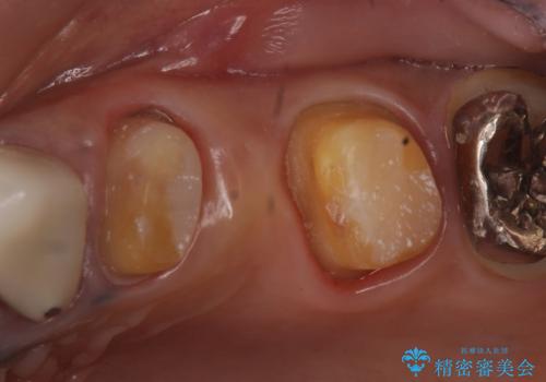 オールセラミッククラウン 不安定なブリッジの再補綴の治療中