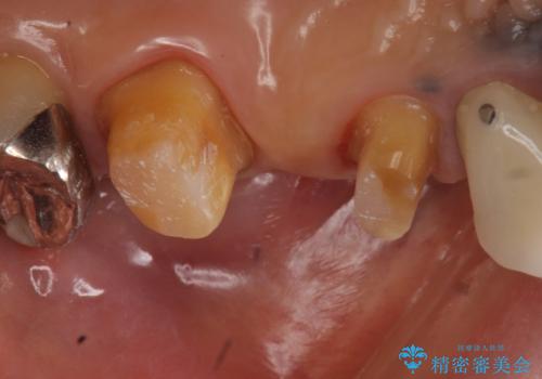 オールセラミッククラウン 不安定なブリッジの再補綴の治療中