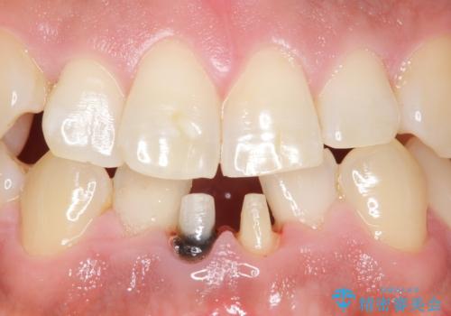 下の前歯の色が気になる セラミックで綺麗に 40代男性の治療中