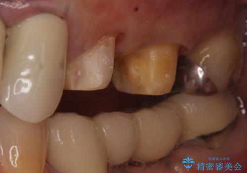 オールセラミッククラウン 不安定なブリッジの再補綴の治療中