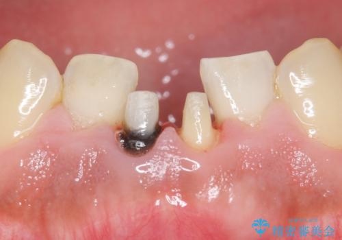 下の前歯の色が気になる セラミックで綺麗に 40代男性の治療中