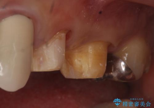 オールセラミッククラウン 不安定なブリッジの再補綴の治療中