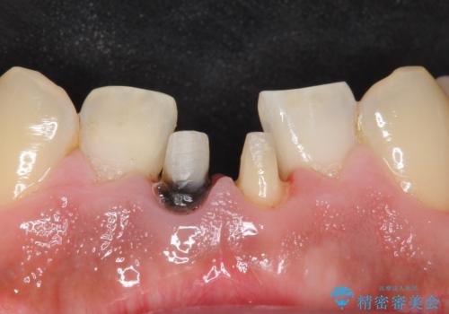 下の前歯の色が気になる セラミックで綺麗に 40代男性の治療中