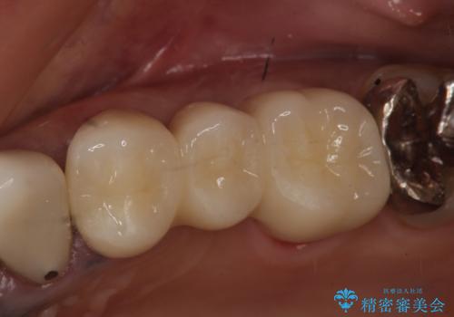 オールセラミッククラウン 不安定なブリッジの再補綴の治療後