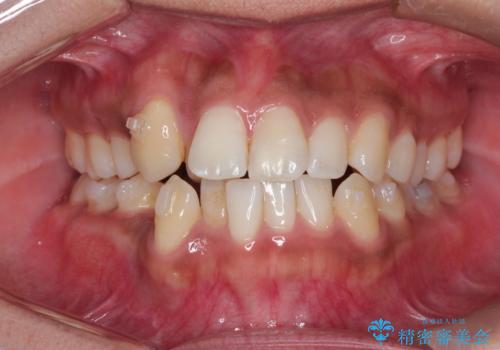 インビザラインと補助装置の併用による八重歯の抜歯矯正の治療中