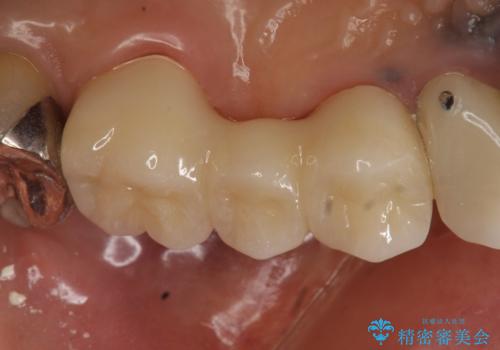 オールセラミッククラウン 不安定なブリッジの再補綴の治療後