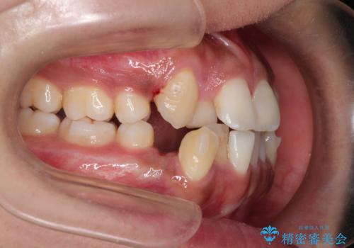インビザラインと補助装置の併用による八重歯の抜歯矯正の治療中