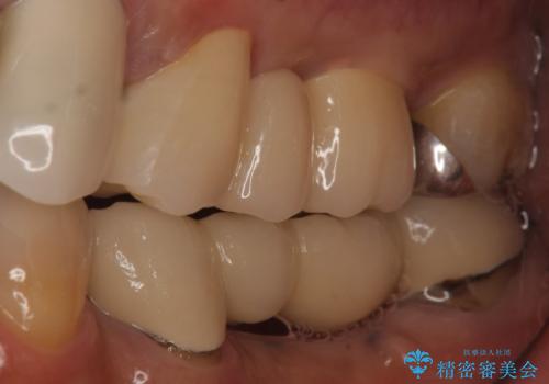 オールセラミッククラウン 不安定なブリッジの再補綴の治療後