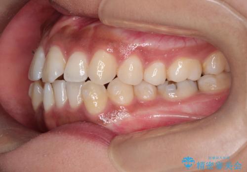 インビザラインと補助装置の併用による八重歯の抜歯矯正の治療中