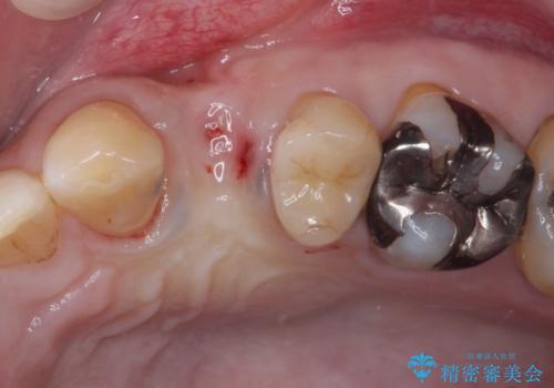 割れてしまった小臼歯 インプラントによる補綴治療の治療前