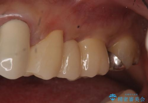 オールセラミッククラウン 不安定なブリッジの再補綴の治療後