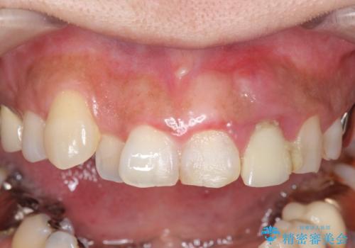 オールセラミッククラウン 根管治療のやり直しの症例 治療前