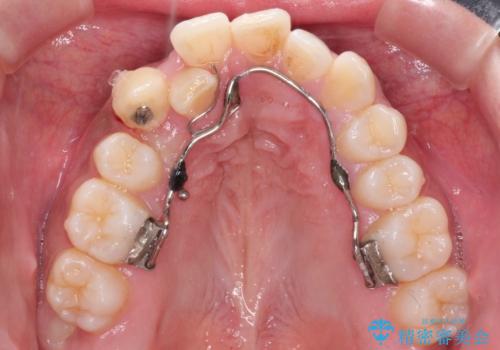 インビザラインと補助装置の併用による八重歯の抜歯矯正の治療中