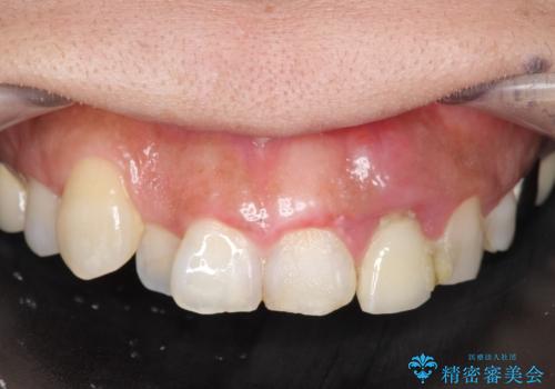 オールセラミッククラウン 根管治療のやり直しの治療前