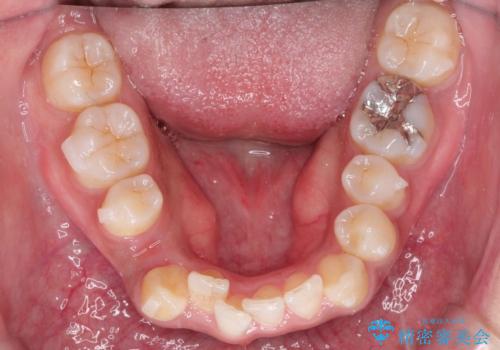 インビザラインと補助装置の併用による八重歯の抜歯矯正の治療中