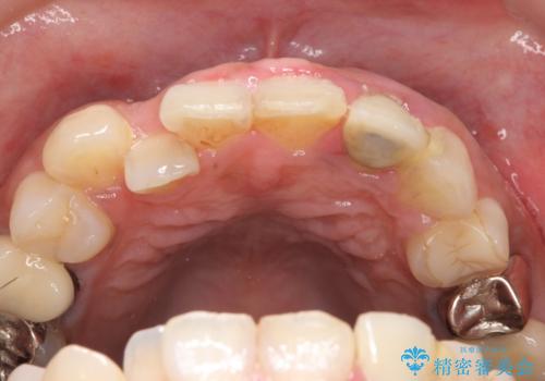 オールセラミッククラウン 根管治療のやり直しの治療前