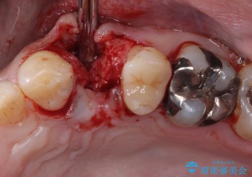 割れてしまった小臼歯 インプラントによる補綴治療の治療中