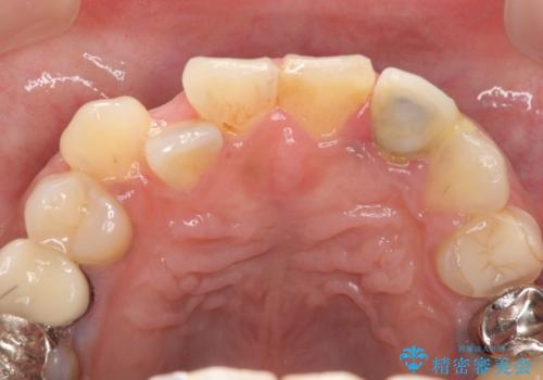 オールセラミッククラウン 根管治療のやり直しの治療前
