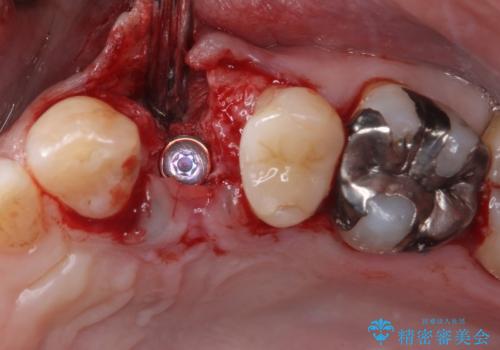 割れてしまった小臼歯 インプラントによる補綴治療の治療後