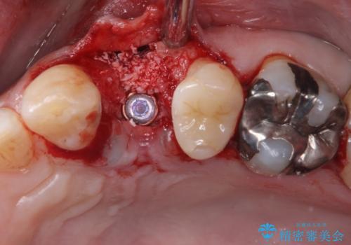 割れてしまった小臼歯 インプラントによる補綴治療の治療前