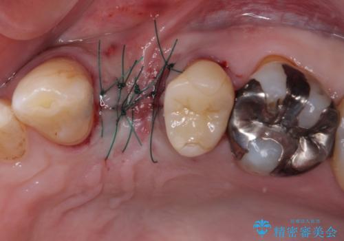 割れてしまった小臼歯 インプラントによる補綴治療の治療中