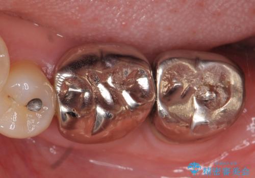 オールセラミッククラウン　激しく痛む歯の再根管治療の症例 治療前