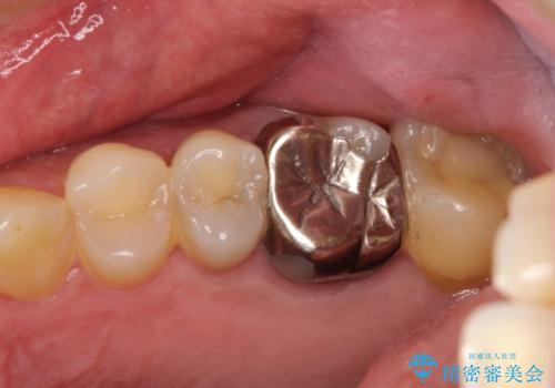 金属をセラミックにしたい、根管治療も行ったケースの症例 治療前